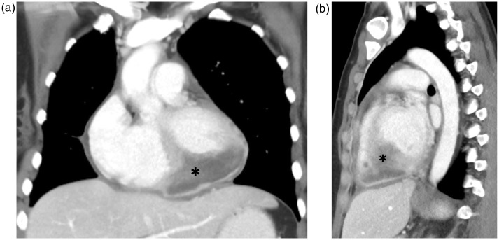 Diagnosis of cardiac metastasis from cervical cancer in a 33-year-old patient using multimodal imaging studies: a case report and literature review.