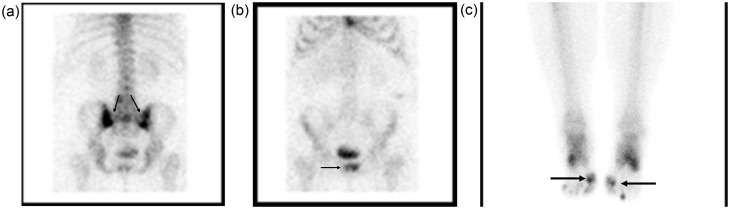 Spinal and sacroiliac gouty arthritis: report of a case and review of the literature.