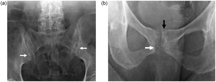 Spinal and sacroiliac gouty arthritis: report of a case and review of the literature.