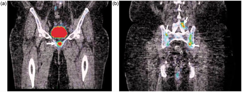 Spinal and sacroiliac gouty arthritis: report of a case and review of the literature.