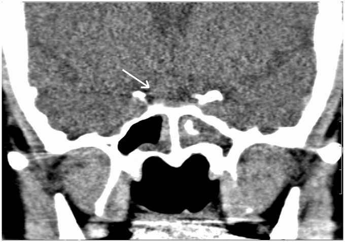 Isolated sphenoid fungal sinusitis and coexisting intrasellar mass lesion presenting with headache as the sole symptom.
