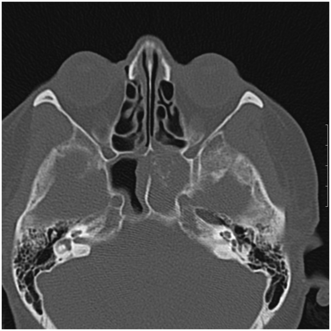 Isolated sphenoid fungal sinusitis and coexisting intrasellar mass lesion presenting with headache as the sole symptom.