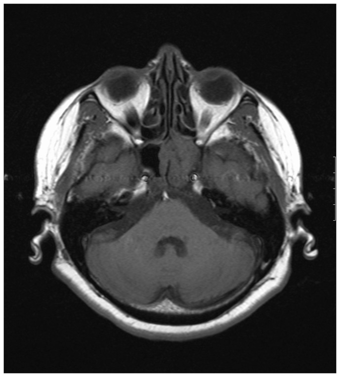 Isolated sphenoid fungal sinusitis and coexisting intrasellar mass lesion presenting with headache as the sole symptom.