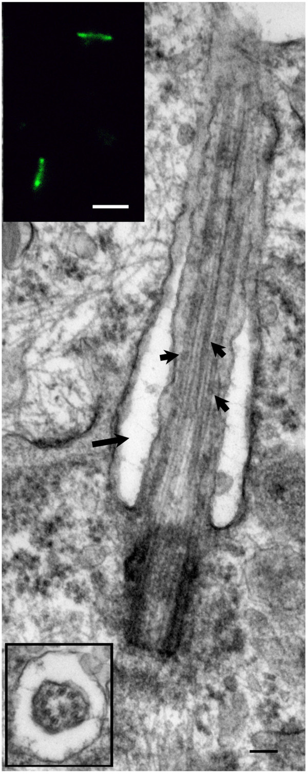 Ultrastructural characterization of primary cilia in pathologically characterized human glioblastoma multiforme (GBM) tumors.