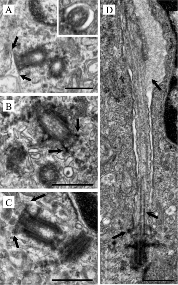 Ultrastructural characterization of primary cilia in pathologically characterized human glioblastoma multiforme (GBM) tumors.