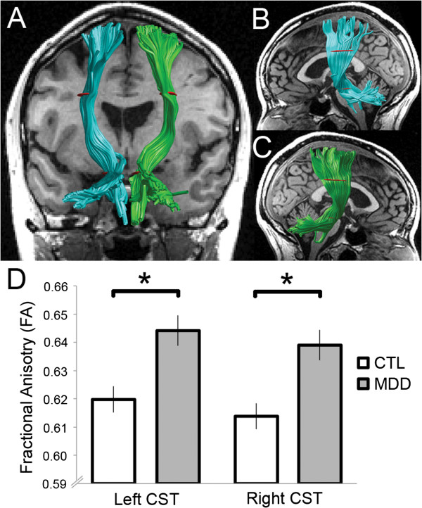 Structural abnormality of the corticospinal tract in major depressive disorder.