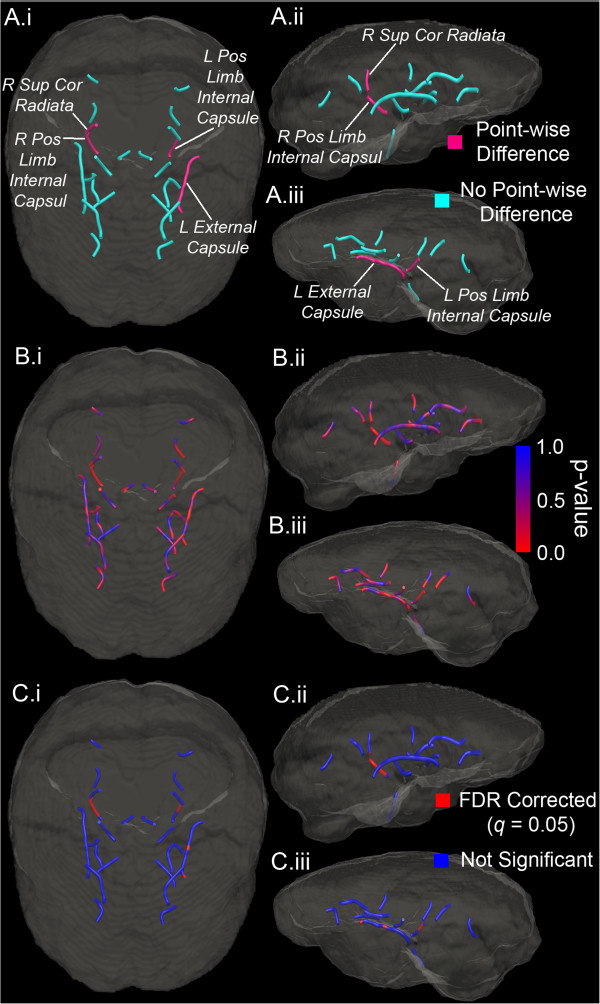 Structural abnormality of the corticospinal tract in major depressive disorder.