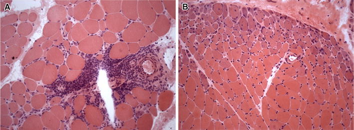 Muscle biopsy features of idiopathic inflammatory myopathies and differential diagnosis.