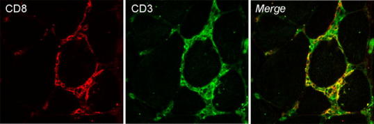 Muscle biopsy features of idiopathic inflammatory myopathies and differential diagnosis.