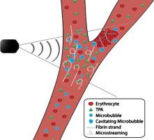 Sonothrombolysis in acute stroke and myocardial infarction: A systematic review