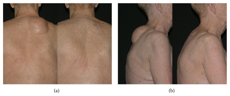 Combined liposuction and excision of lipomas: long-term evaluation of a large sample of patients.
