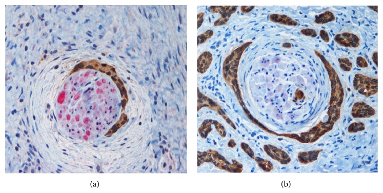 Dual S-100-AE1/3 Immunohistochemistry to Detect Perineural Invasion in Nonmelanoma Skin Cancers.