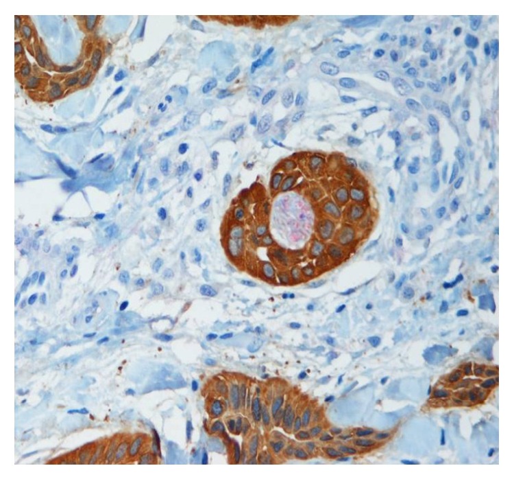 Dual S-100-AE1/3 Immunohistochemistry to Detect Perineural Invasion in Nonmelanoma Skin Cancers.