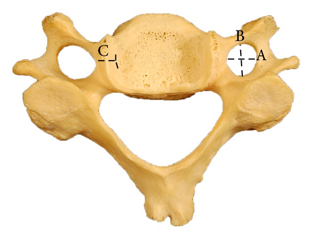 Dimensions and Anatomical Variants of the Foramen Transversarium of Typical Cervical Vertebrae.