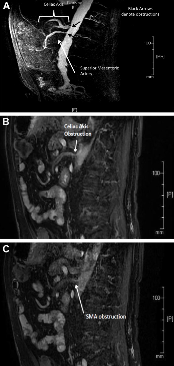 Management of Loose, Frequent Stools and Fecal Incontinence in a Chronic Mesenteric Ischemia Patient with Oral Serum-derived Bovine Immunoglobulin.