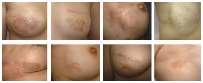 Nummular Eczema of Breast: A Potential Dermatologic Complication after Mastectomy and Subsequent Breast Reconstruction.