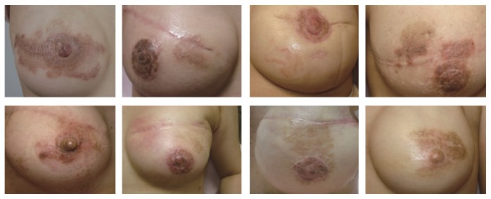 Nummular Eczema of Breast: A Potential Dermatologic Complication after Mastectomy and Subsequent Breast Reconstruction.