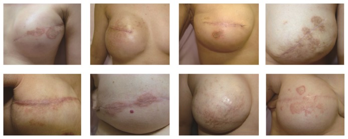 Nummular Eczema of Breast: A Potential Dermatologic Complication after Mastectomy and Subsequent Breast Reconstruction.