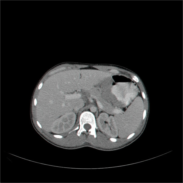 Primary gastric lymphoma in a soldier presenting as acute gastrointestinal bleeding.