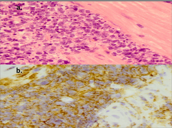 Primary gastric lymphoma in a soldier presenting as acute gastrointestinal bleeding.