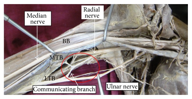 Anatomical Study of the Ulnar Nerve Variations at High Humeral Level and Their Possible Clinical and Diagnostic Implications.