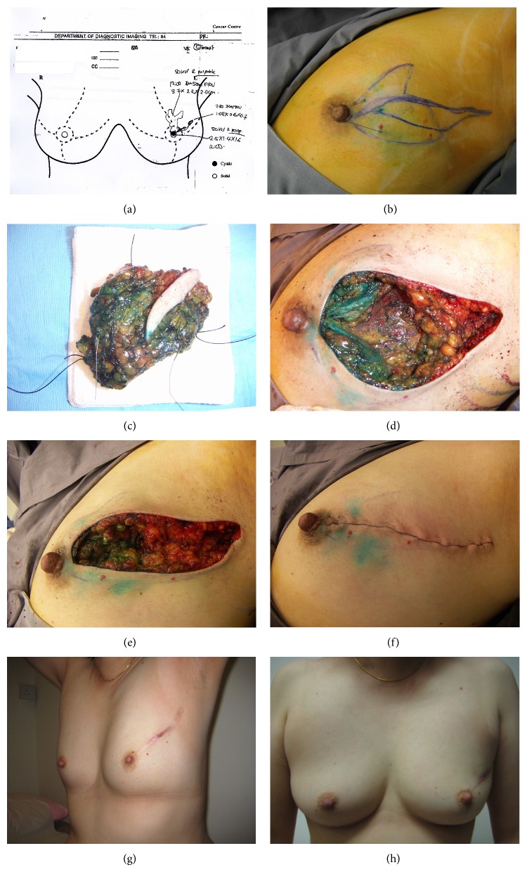 Minimising unnecessary mastectomies in a predominantly Chinese community.