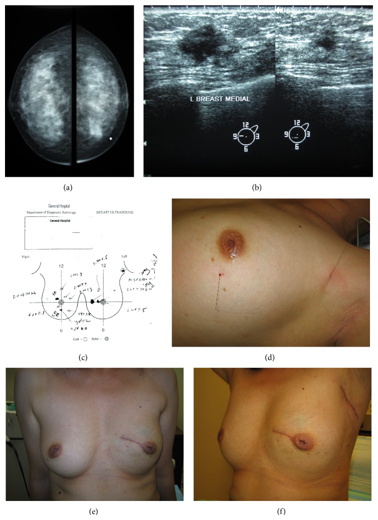 Minimising unnecessary mastectomies in a predominantly Chinese community.