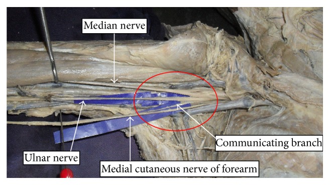 Anatomical Study of the Ulnar Nerve Variations at High Humeral Level and Their Possible Clinical and Diagnostic Implications.