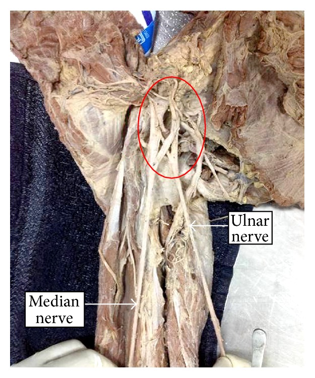 Anatomical Study of the Ulnar Nerve Variations at High Humeral Level and Their Possible Clinical and Diagnostic Implications.
