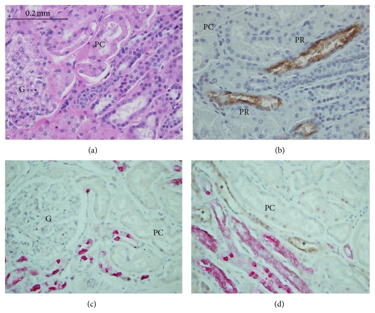 Proximal Tubular Injury in Medullary Rays Is an Early Sign of Acute Tacrolimus Nephrotoxicity.