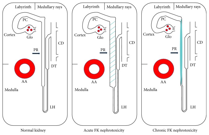 Proximal Tubular Injury in Medullary Rays Is an Early Sign of Acute Tacrolimus Nephrotoxicity.