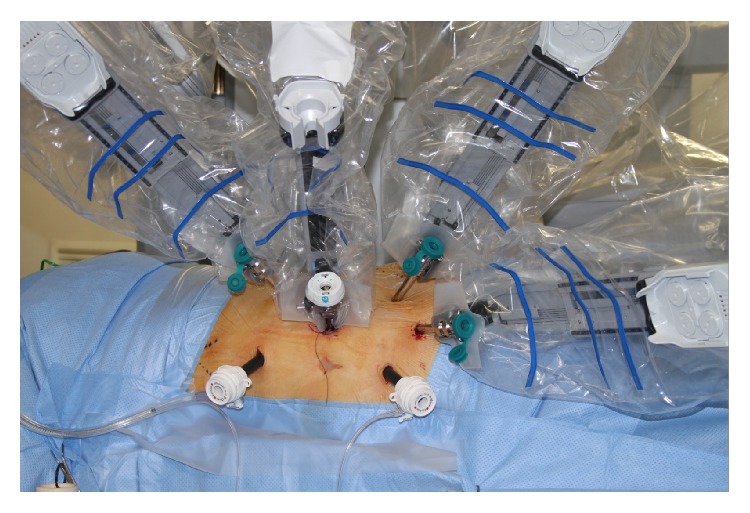 Early Experience in Da Vinci Robot-Assisted Partial Nephrectomy: An Australian Single Centre Series.