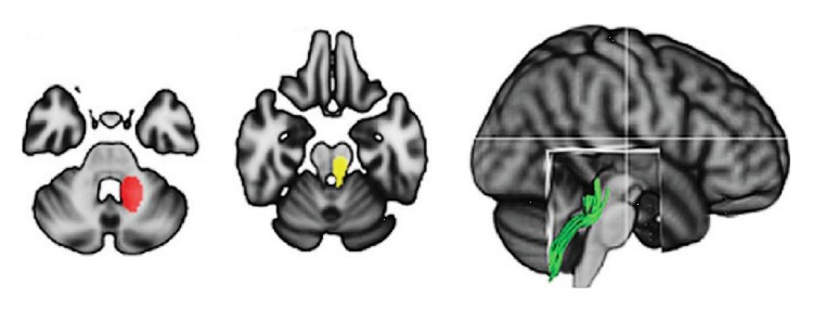 Functional and Structural Brain Plasticity Enhanced by Motor and Cognitive Rehabilitation in Multiple Sclerosis.