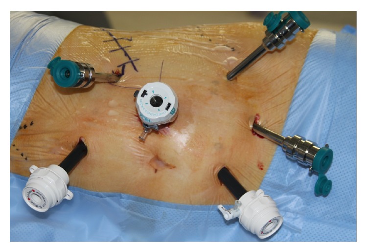 Early Experience in Da Vinci Robot-Assisted Partial Nephrectomy: An Australian Single Centre Series.