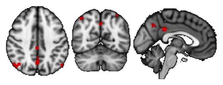 Functional and Structural Brain Plasticity Enhanced by Motor and Cognitive Rehabilitation in Multiple Sclerosis.