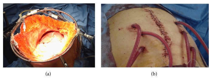 Peritoneal carcinomatosis: intraoperative parameters in open (coliseum) versus closed abdomen HIPEC.