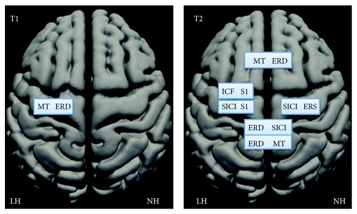 Cortical Excitability Measured with nTMS and MEG during Stroke Recovery.