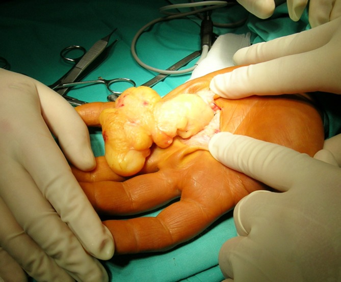 Statistical and histological analysis of tumors of the upper extremity.
