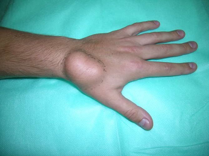 Statistical and histological analysis of tumors of the upper extremity.