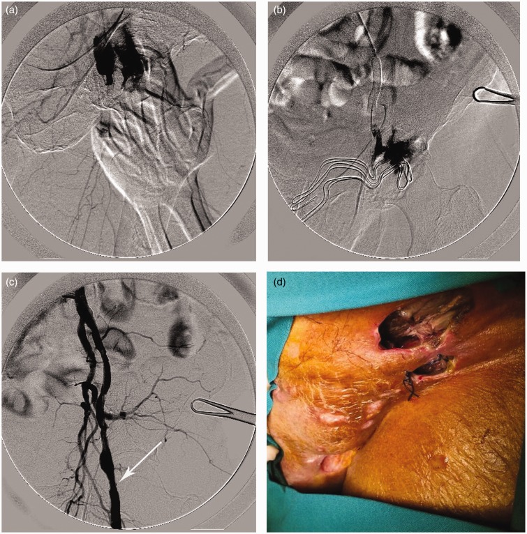 Emergency endovascular management of the common femoral artery rupture due to radiotherapy for scrotal carcinoma.