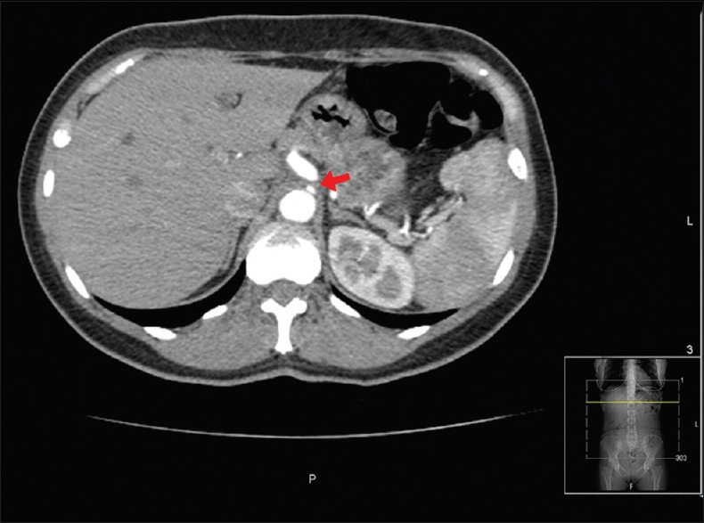 A Rare Cause of Postprandial Abdominal Pain.