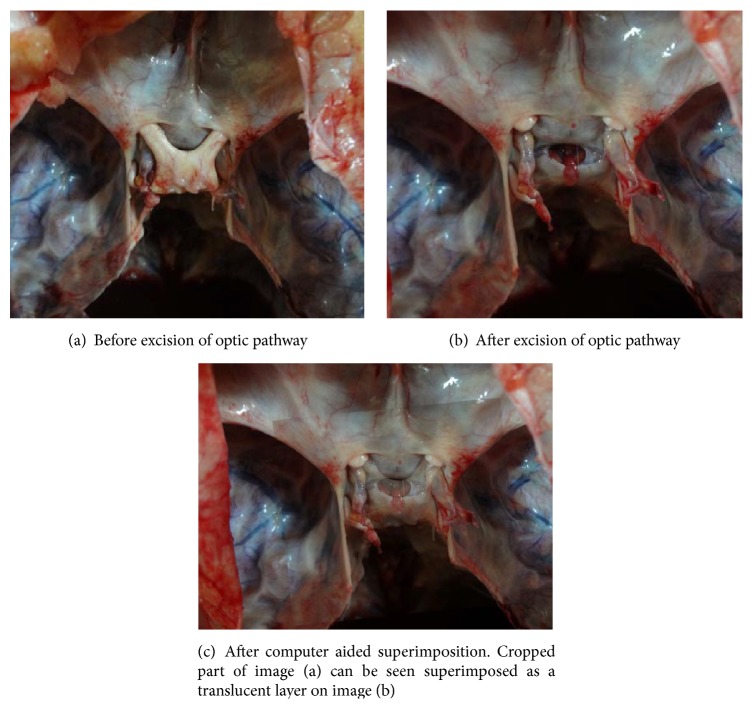 A Morphometric Study of the Foramen of Diaphragma Sellae and Delineation of Its Relation to Optic Neural Pathways through Computer Aided Superimposition.