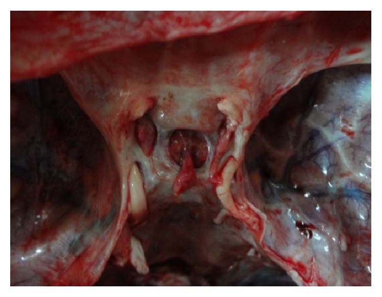 A Morphometric Study of the Foramen of Diaphragma Sellae and Delineation of Its Relation to Optic Neural Pathways through Computer Aided Superimposition.