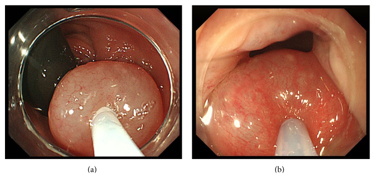 Treatment of Internal Hemorrhoids by Endoscopic Sclerotherapy with Aluminum Potassium Sulfate and Tannic Acid.