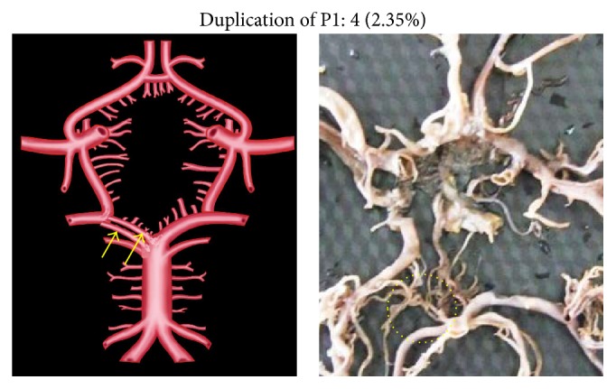 Study of Posterior Cerebral Artery in Human Cadaveric Brain.