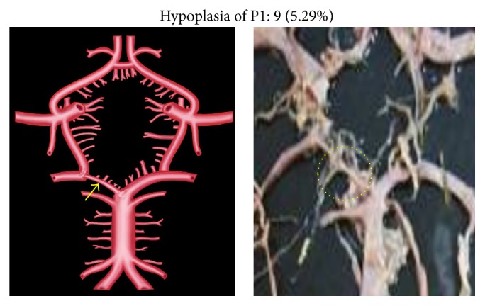 Study of Posterior Cerebral Artery in Human Cadaveric Brain.