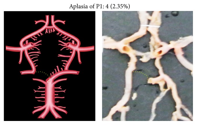 Study of Posterior Cerebral Artery in Human Cadaveric Brain.