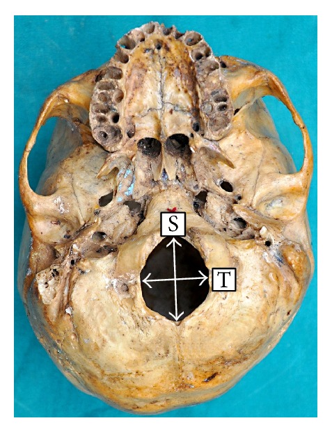 Binary Logistic Regression Analysis of Foramen Magnum Dimensions for Sex Determination.