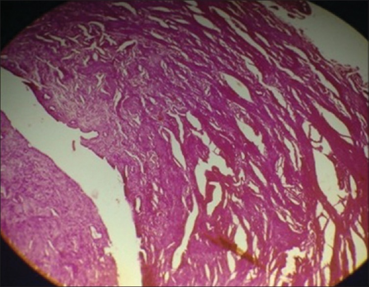Persistent Mullerian Duct Syndrome with Transverse Testicular Ectopia.