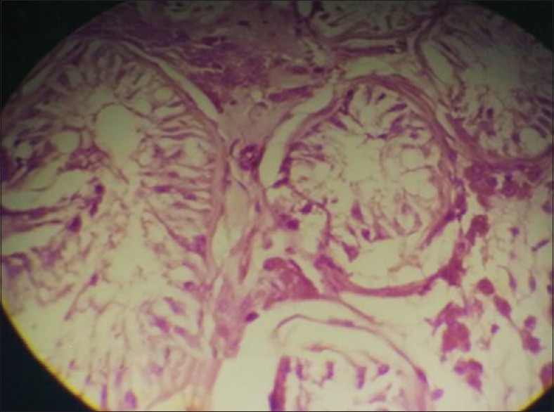 Persistent Mullerian Duct Syndrome with Transverse Testicular Ectopia.